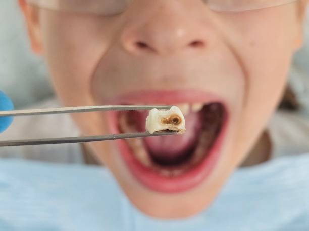 Best Emergency Dentist for Lost Fillings or Crowns in Ash Flat, AR